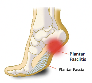 Plantar Fasciitis 1 Screenshot 2024 03 22 at 13.01.56