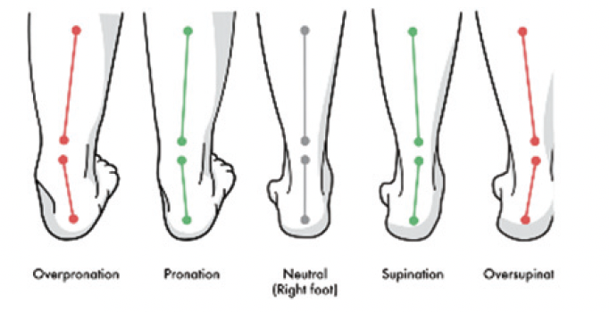 Overpronation 2 Screenshot 2024 05 23 at 07.42.35